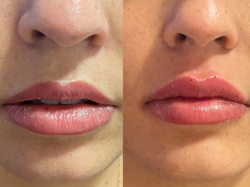 Lábios finos: como o preenchimento labial pode valorizar sua beleza natural