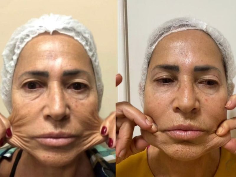 Bioestimulador de colágeno funciona mesmo? Veja os resultados esperados