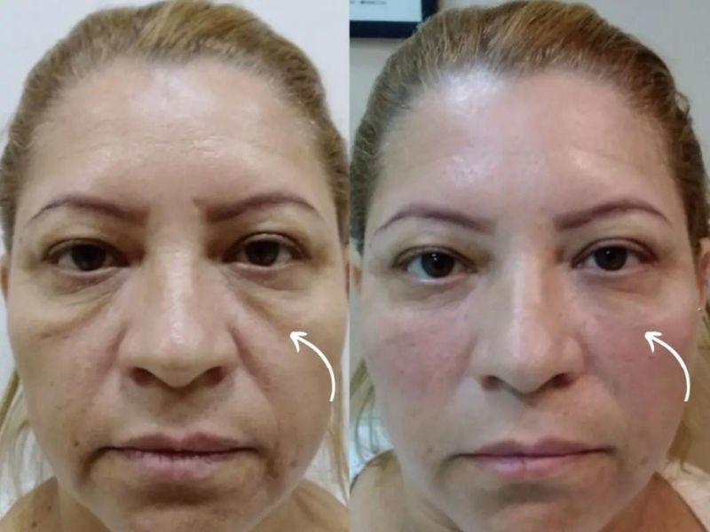 Preenchimento facial: o que é, para que serve e quais áreas podem ser tratadas?